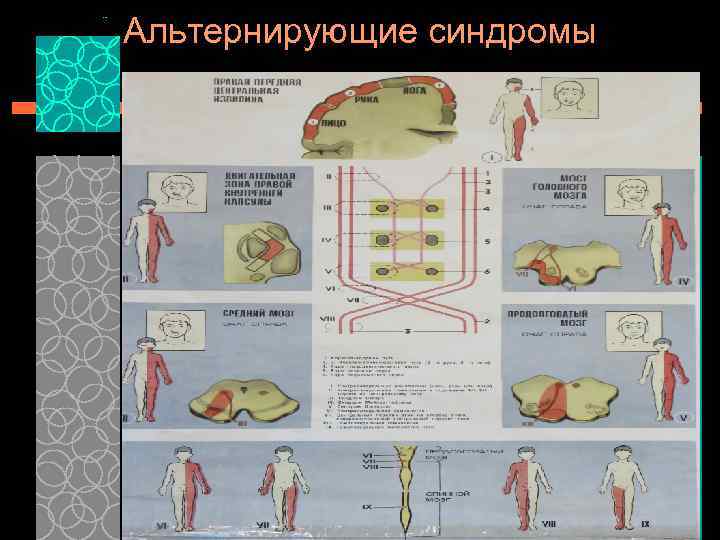 Синдром мийяра гюблера