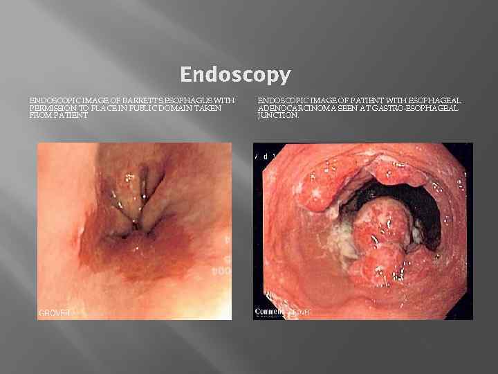 Endoscopy ENDOSCOPIC IMAGE OF BARRETT'S ESOPHAGUS WITH PERMISSION TO PLACE IN PUBLIC DOMAIN TAKEN