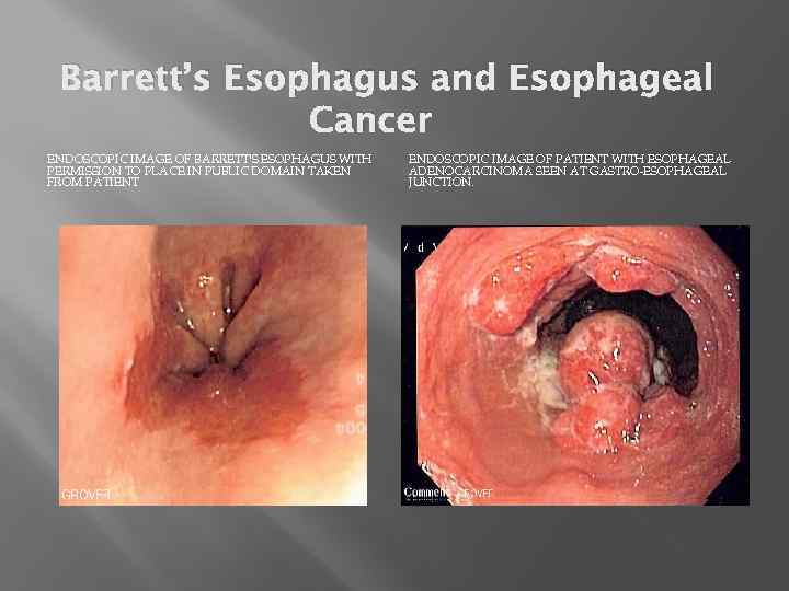 Barrett’s Esophagus and Esophageal Cancer ENDOSCOPIC IMAGE OF BARRETT'S ESOPHAGUS WITH PERMISSION TO PLACE