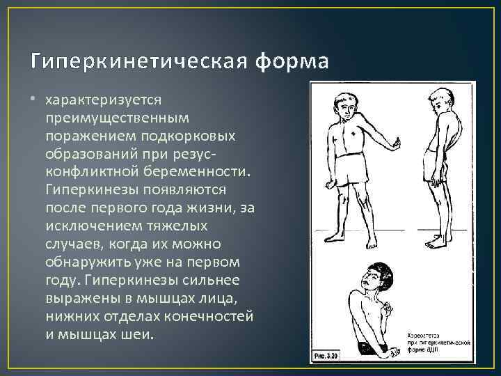 Гиперкинетическая форма • характеризуется преимущественным поражением подкорковых образований при резусконфликтной беременности. Гиперкинезы появляются после