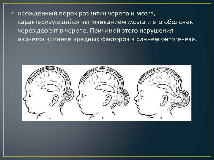  • врождённый порок развития черепа и мозга, характеризующийся выпячиванием мозга и его оболочек