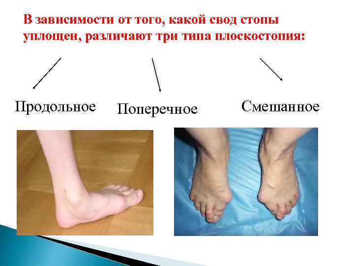 В зависимости от того, какой свод стопы уплощен, различают три типа плоскостопия: Продольное Поперечное