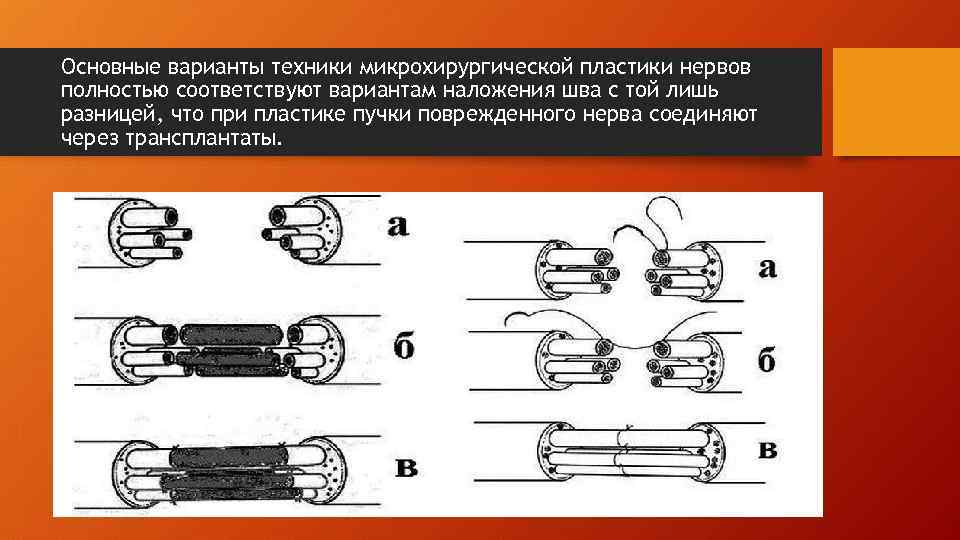 Основные варианты техники микрохирургической пластики нервов полностью соответствуют вариантам наложения шва с той лишь
