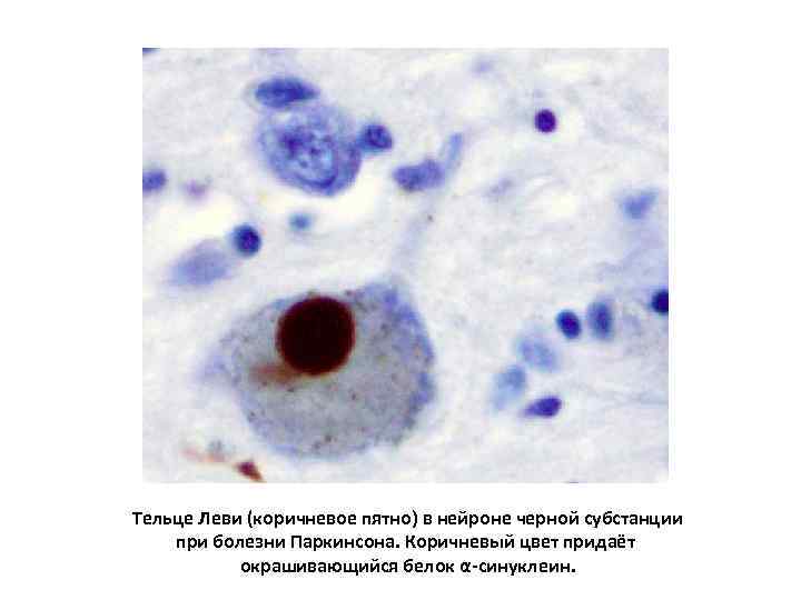 Тельце Леви (коричневое пятно) в нейроне черной субстанции при болезни Паркинсона. Коричневый цвет придаёт