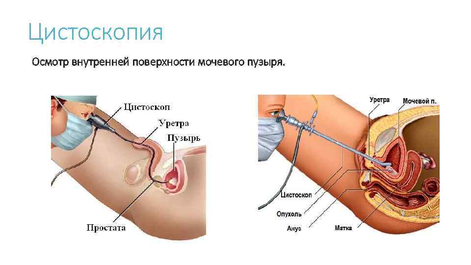 Цистоскопия Осмотр внутренней поверхности мочевого пузыря. 