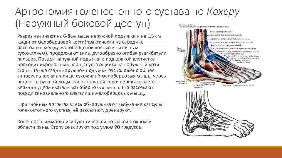 Артротомия голеностопного сустава по Кохеру (Наружный боковой доступ) Разрез начинают на 6 -8 см