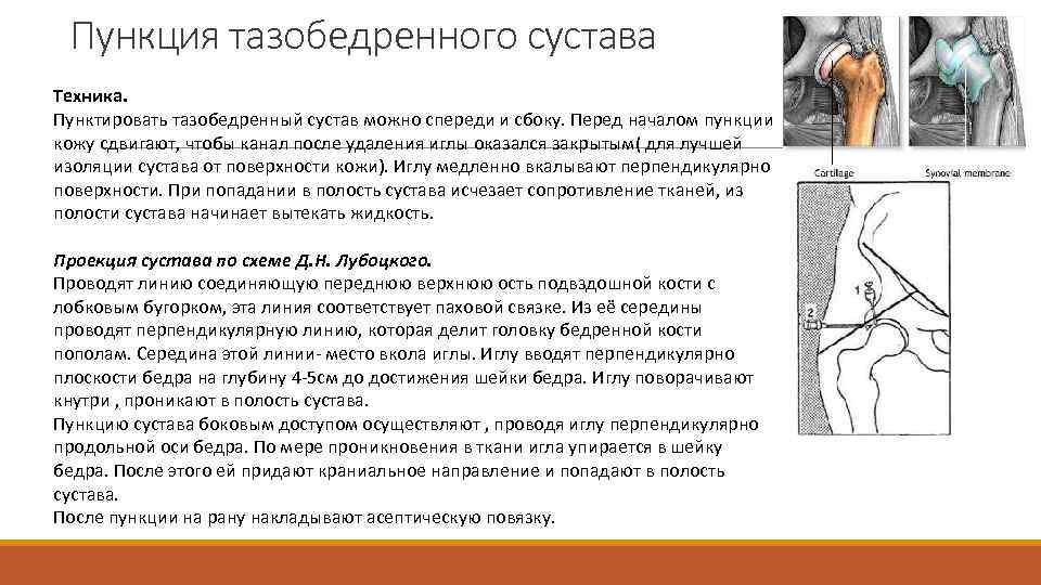 Пункция тазобедренного сустава Техника. Пунктировать тазобедренный сустав можно спереди и сбоку. Перед началом пункции