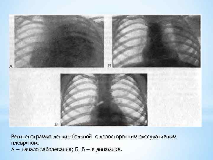 Рентгенограмма легких больной с левосторонним экссудативным плевритом. А — начало заболевания; Б, В —
