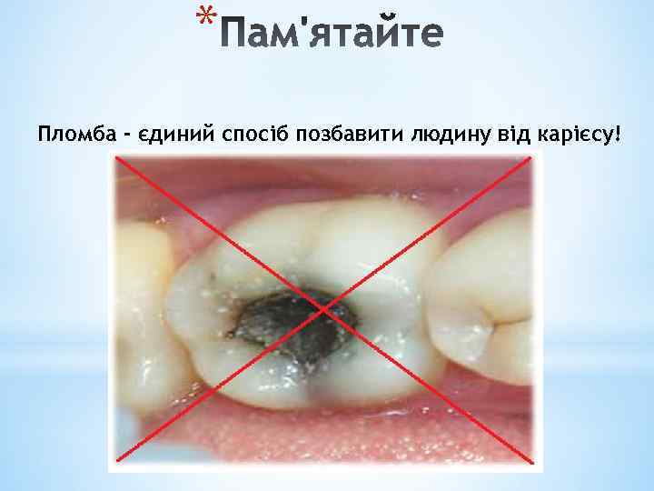 * Пломба - єдиний спосіб позбавити людину від карієсу! 