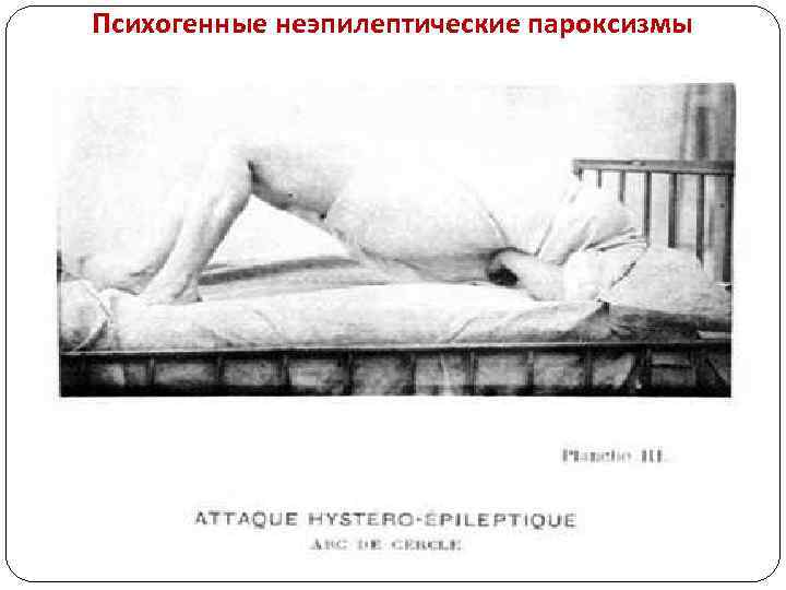 Психогенные неэпилептические пароксизмы 