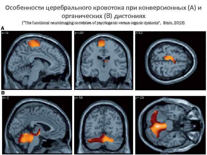 Особенности церебрального кровотока при конверсионных (А) и органических (B) дистониях (“The functional neuroimaging correlates