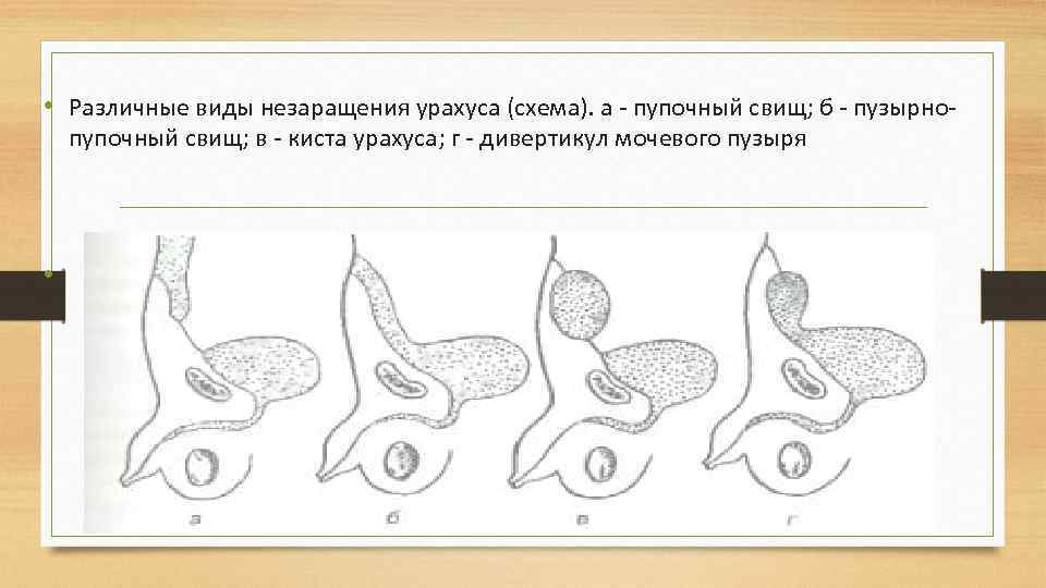  • Различные виды незаращения урахуса (схема). а пупочный свищ; б пузырно пупочный свищ;