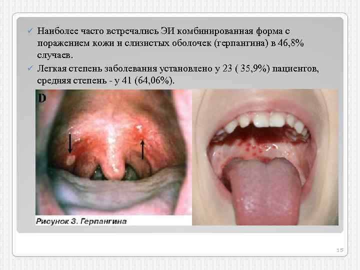 Наиболее часто встречались ЭИ комбинированная форма с поражением кожи и слизистых оболочек (герпангина) в