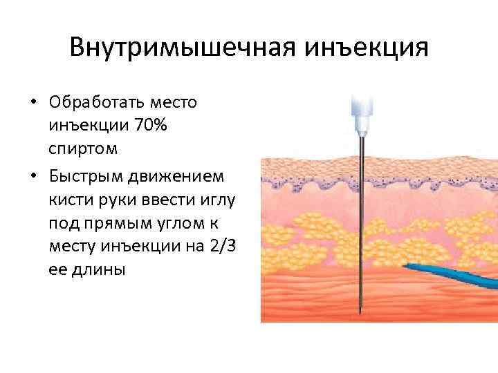 Внутримышечная инъекция • Обработать место инъекции 70% спиртом • Быстрым движением кисти руки ввести