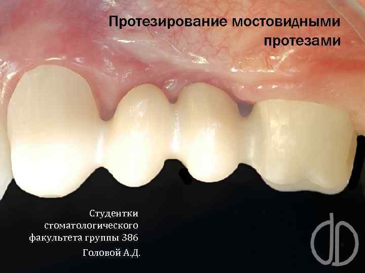 Протезирование мостовидными протезами Студентки стоматологического факультета группы 386 Головой А. Д. 