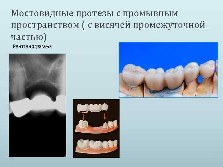 Изготовление мостовидных протезов презентация