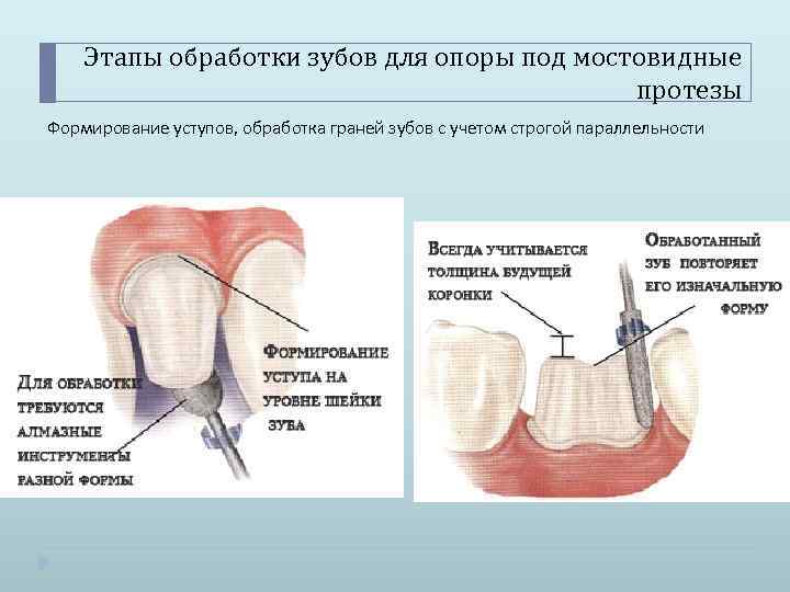 Чем можно обработать зуб