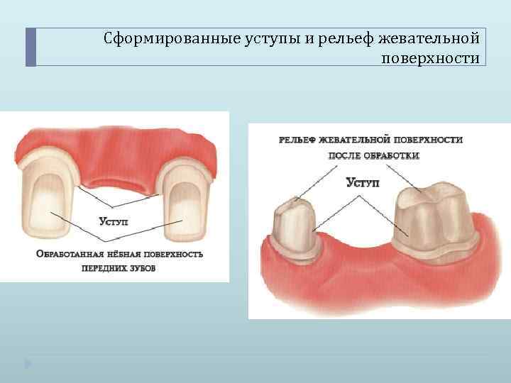 Сформированные уступы и рельеф жевательной поверхности 