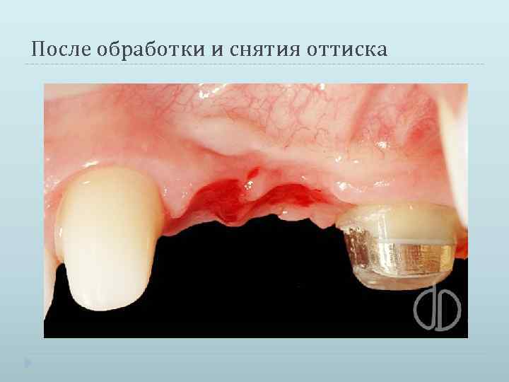 Снятие оттиска индивидуальной ложкой под псп