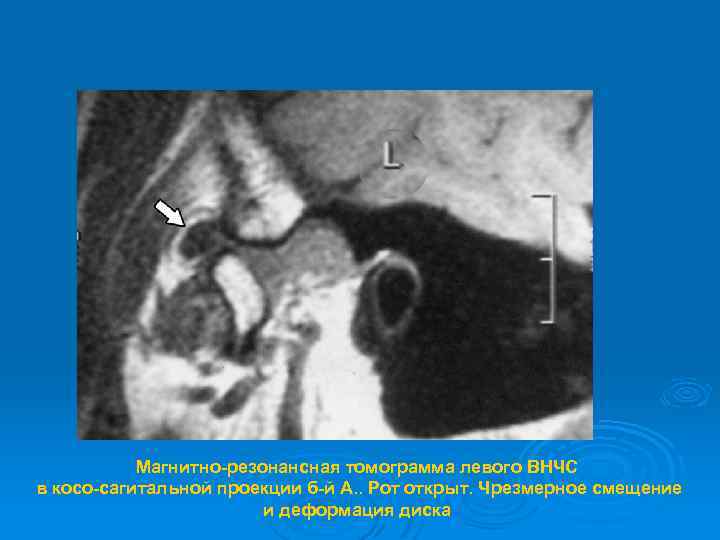 Магнитно-резонансная томограмма левого ВНЧС в косо-сагитальной проекции б-й А. . Рот открыт. Чрезмерное смещение