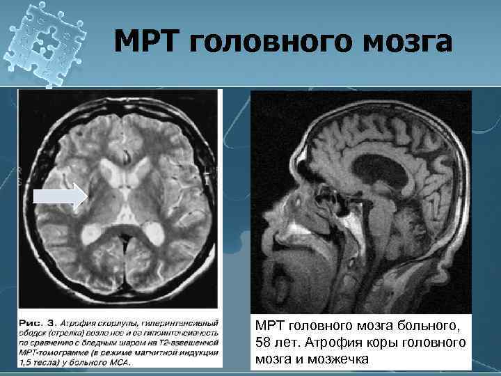 МРТ головного мозга больного, 58 лет. Атрофия коры головного мозга и мозжечка 