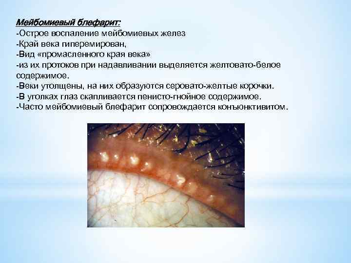 Мейбомиевый блефарит: -Острое воспаление мейбомиевых желез -Край века гиперемирован, -Вид «промасленного края века» -из