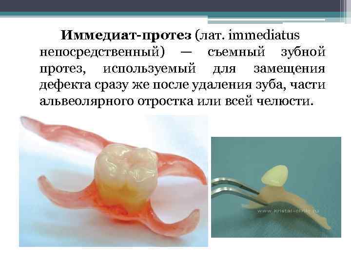 Клинико лабораторные этапы пластиночных протезов. Иммедиат протезы клинико лабораторные. Микропротез, иммедиат-протез (до 4-х искусственных зубов).