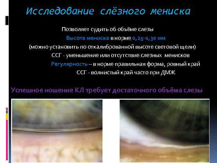 Исследование слёзного мениска Позволяет судить об объёме слезы Высота мениска в норме 0, 25