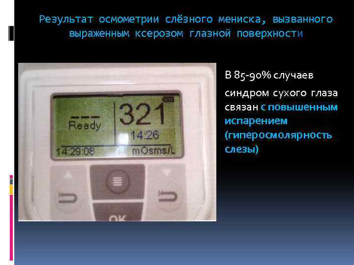 Результат осмометрии слёзного мениска, вызванного выраженным ксерозом глазной поверхности В 85 -90% случаев синдром