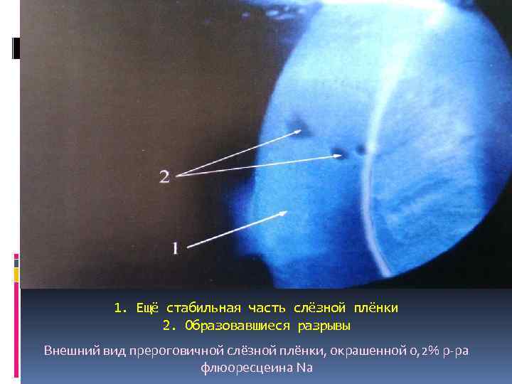 1. Ещё стабильная часть слёзной плёнки 2. Образовавшиеся разрывы Внешний вид прероговичной слёзной плёнки,