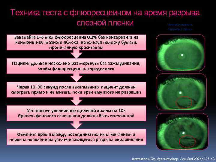 Техника теста с флюоресцеином на время разрыва слезной пленки Нестабильность слезной пленки Закапайте 1–