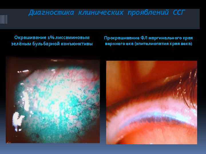 Диагностика клинических проявлений ССГ Окрашивание 1% лиссаминовым зелёным бульбарной конъюнктивы Прокрашивание ФЛ маргинального края