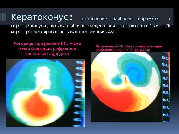 Кератоконус: истончение наиболее выражено в вершине конуса, которая обычно смещена вниз от зрительной оси.