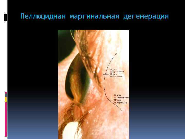 Пеллюцидная маргинальная дегенерация 