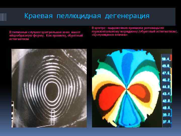 Краевая пеллюцидная дегенерация В типичных случаях центральная зона имеет яйцеобразную форму. Как правило, обратный