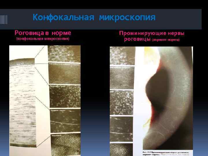 Конфокальная микроскопия Роговица в норме (конфокальная микроскопия) Проминирующие нервы роговицы (вариант нормы) 