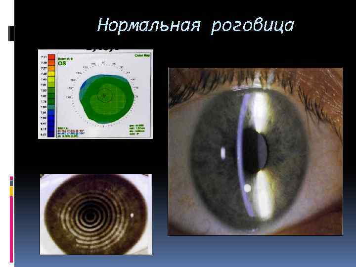 Нормальная роговица 