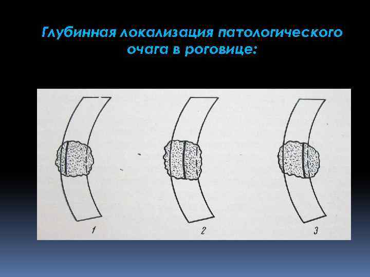 Глубинная локализация патологического очага в роговице: 