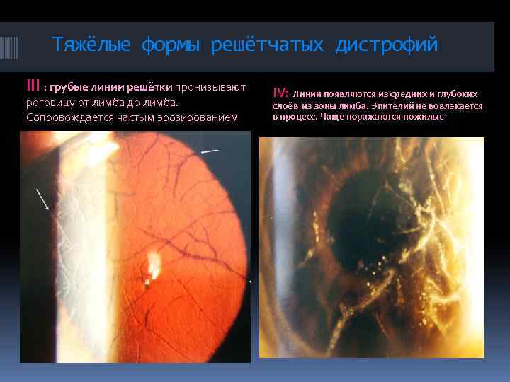 Тяжёлые формы решётчатых дистрофий III : грубые линии решётки пронизывают роговицу от лимба до