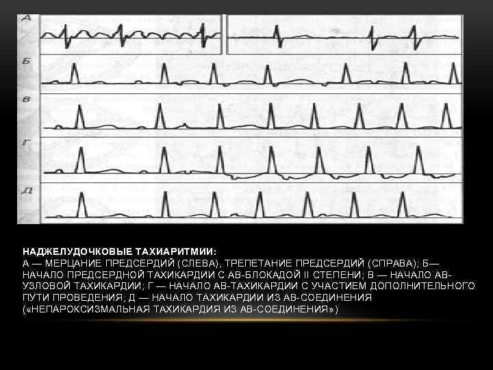 НАДЖЕЛУДОЧКОВЫЕ ТАХИАРИТМИИ: А — МЕРЦАНИЕ ПРЕДСЕРДИЙ (СЛЕВА), ТРЕПЕТАНИЕ ПРЕДСЕРДИЙ (СПРАВА); Б— НАЧАЛО ПРЕДСЕРДНОЙ ТАХИКАРДИИ