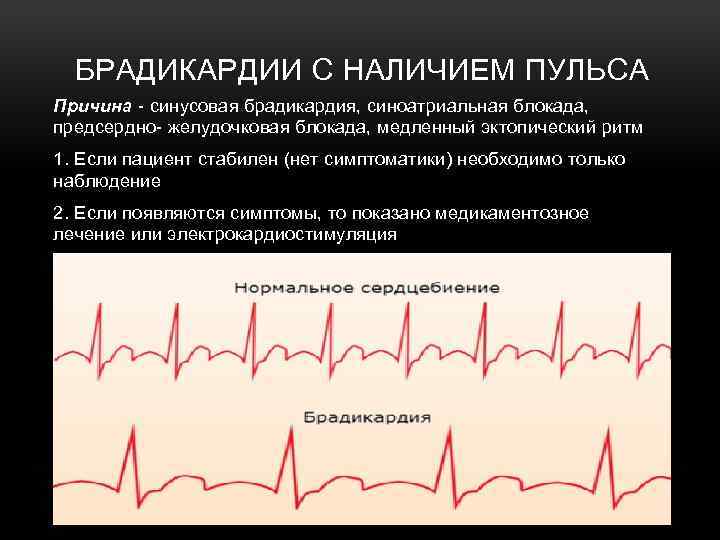  БРАДИКАРДИИ С НАЛИЧИЕМ ПУЛЬСА Причина - синусовая брадикардия, синоатриальная блокада, предсердно- желудочковая блокада,