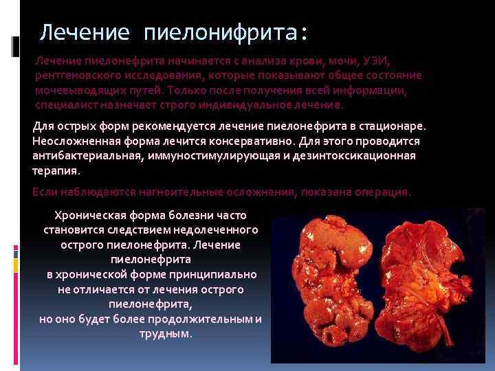 Лечение пиелонифрита: Лечение пиелонефрита начинается с анализа крови, мочи, УЗИ, рентгеновского исследования, которые показывают