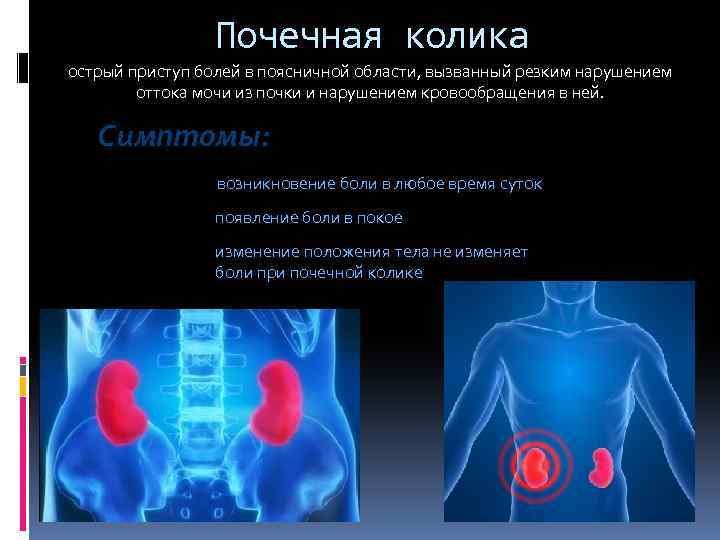 Почечная колика острый приступ болей в поясничной области, вызванный резким нарушением оттока мочи из