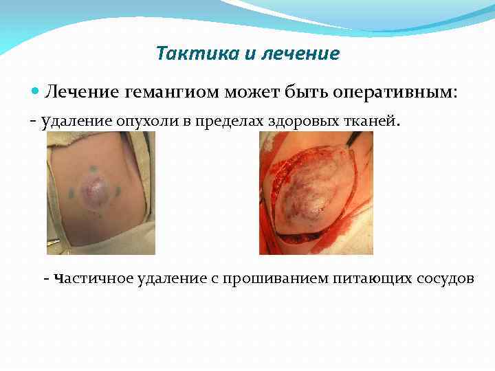 Тактика и лечение Лечение гемангиом может быть оперативным: удаление опухоли в пределах здоровых тканей.