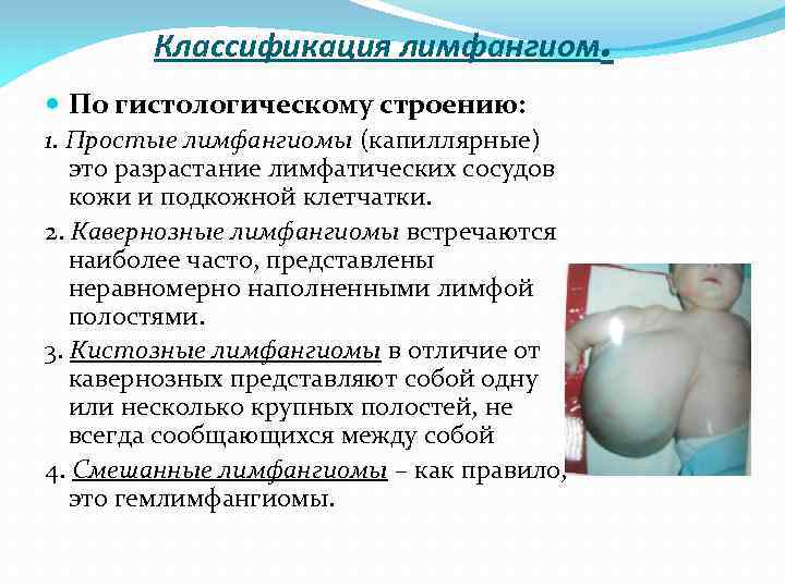 Классификация лимфангиом. По гистологическому строению: 1. Простые лимфангиомы (капиллярные) это разрастание лимфатических сосудов кожи