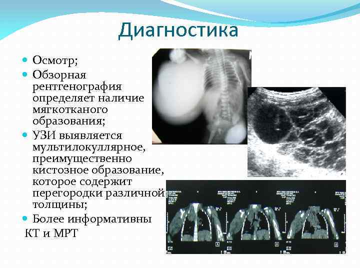Диагностика Осмотр; Обзорная рентгенография определяет наличие мягкотканого образования; УЗИ выявляется мультилокуллярное, преимущественно кистозное образование,