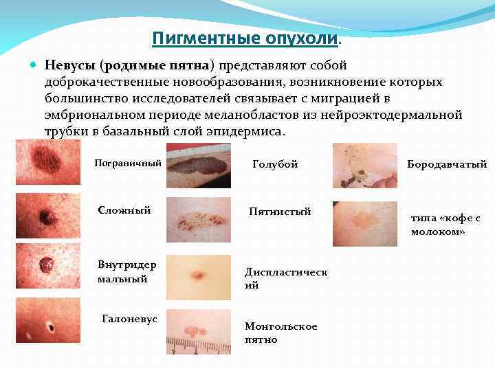 Пигментные опухоли. Невусы (родимые пятна) представляют собой доброкачественные новообразования, возникновение которых большинство исследователей связывает