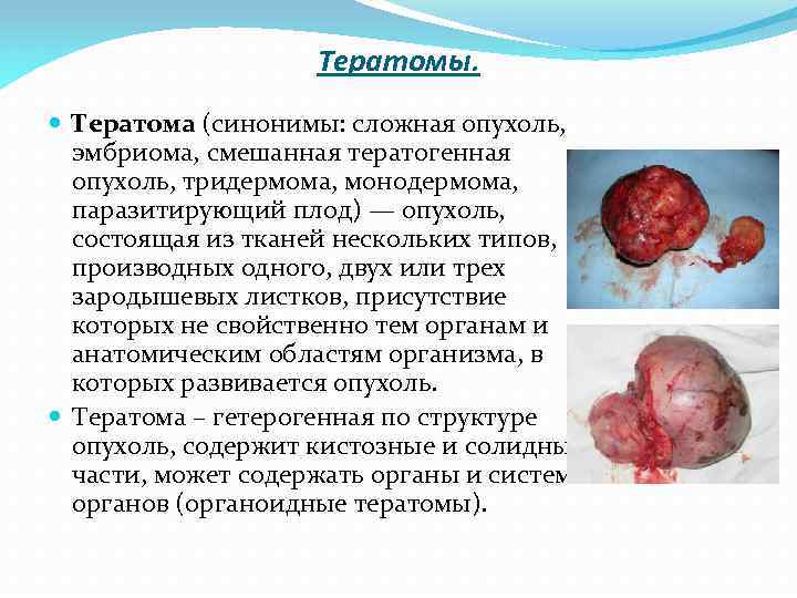 Тератомы. Тератома (синонимы: сложная опухоль, эмбриома, смешанная тератогенная опухоль, тридермома, монодермома, паразитирующий плод) —