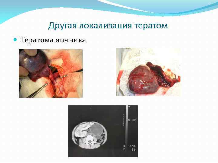 Другая локализация тератом Тератома яичника 