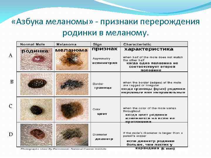  «Азбука меланомы» - признаки перерождения родинки в меланому. А В С D 